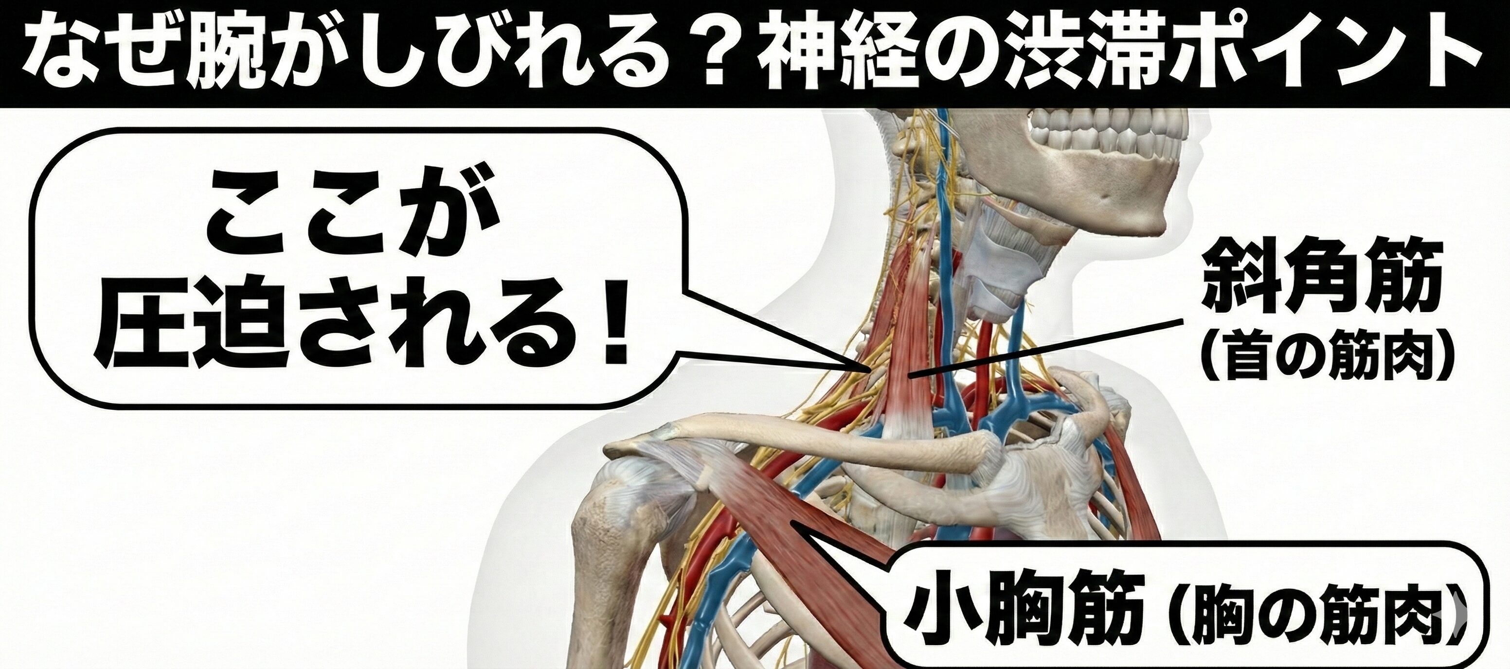 胸郭出口症候群の原因となる神経の圧迫ポイントを図解したイラスト。首の斜角筋と胸の小胸筋（烏口突起から第3〜5肋骨に付着）が交通事故の衝撃で緊張し、腕に向かう神経や血管を挟み込んで「渋滞」させている様子を解説している。
